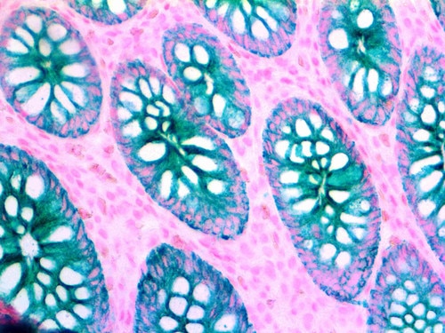 Cytokeratin OSCAR Antibody Immunohistochemistry on a FFPE Colon Carcinoma Tissue